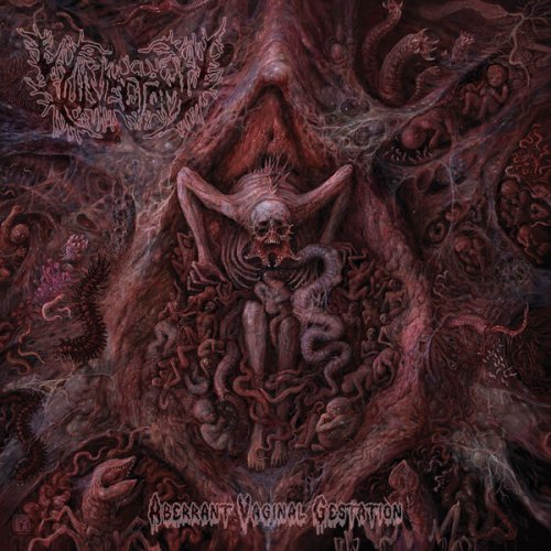 Vulvectomy - Aberrant Vaginal Gestation (2025)